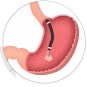 Эндоскопия желудка (гастроскопия, ЭГДС, эзофагогастродуоденоскопия)
