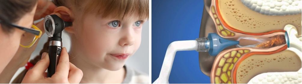 Домашние условия лечения уха ребенку: 4 эффективных способа