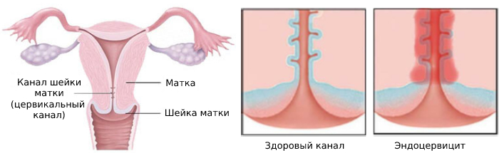 Эндоцервицит — воспаление канала шейки матки