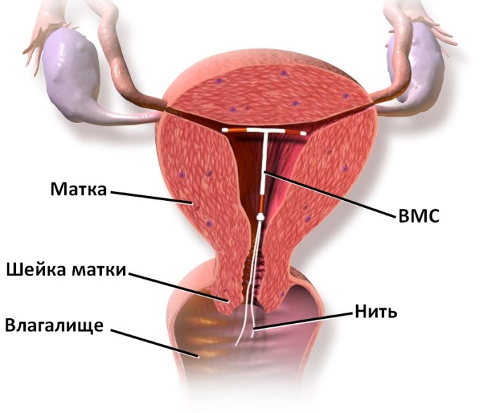 Обильные менструации – спасение есть! | FemClinic