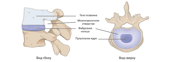 Остеохондроз шейного отдела позвоночника. Вторая стадия - разрушается фиброзное кольцо. 