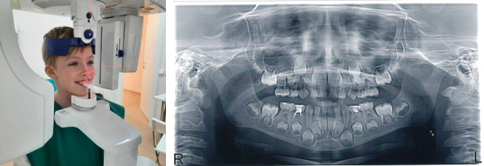 Ортопантомограмма - панорамный снимок зубов детям