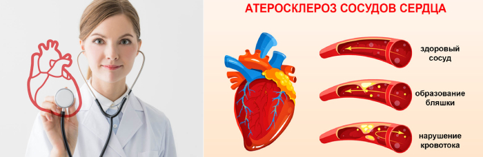 Атеросклеротическая болезнь сердца - причины, симптомы и лечение