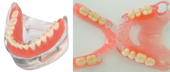 Виды бюгельных зубных протезов