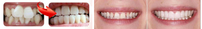 Капы для выравнивания зубов - до и после использования