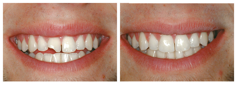 Реставрация фотополимером. Реставрированные передние зубы. Наращивание передних зубов до и после.