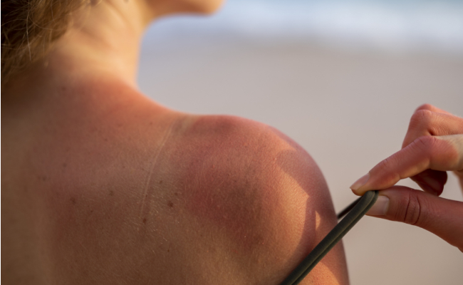 Аллергия на солнце: что это такое, как выглядит и как ее лечить