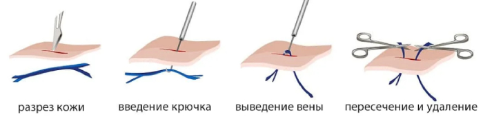 При минифлебэктомии делается небольшие проколы величиной до 2 мм с помощью скальпеля с узким лезвием или иглой и удаляется небольшая вена