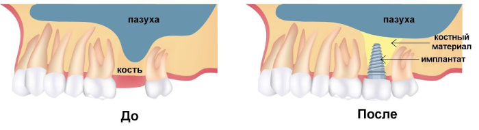Синус-лифтинг - наращивание кости для импланта в стоматологии