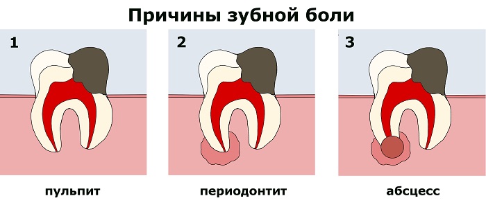 Причины зубной боли - пульпит, периодонтит, абсцесс