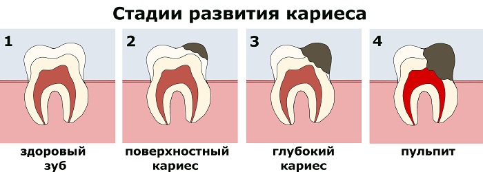 Пломбирование зуба - стадии кариеса