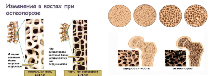 Остеопороз - схема снижения плотности костной ткани